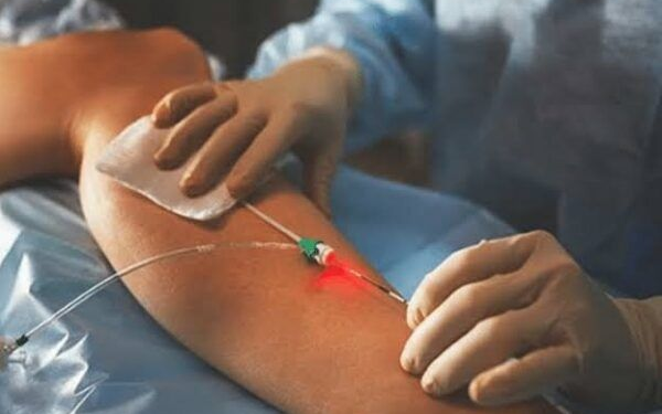 Laser Varicose Vein Surgery